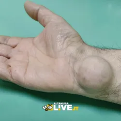 Neurochirurgia al Di Venere, intervento di alta precisione salva la mano a un 60enne. Rimosso raro tumore grande più di 3cm
